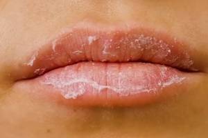 8 причин шелушения губ, как их быстро вылечить