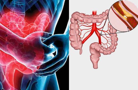 6 признаков, что у вас ишемия кишечника