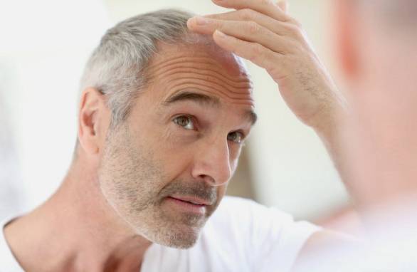 8 причин, почему мужчины лысеют