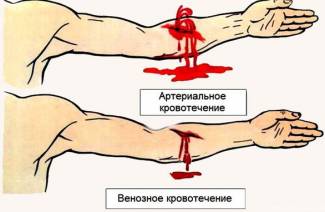 Признаки артериального кровотечения