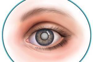7 признаков катаракты
