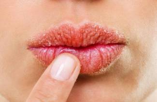 6 способов избежать потрескавшихся губ