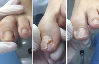 Протезирование ногтей на ногах