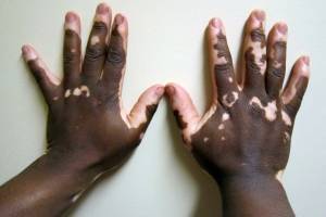 5 наследственных проблем с кожей