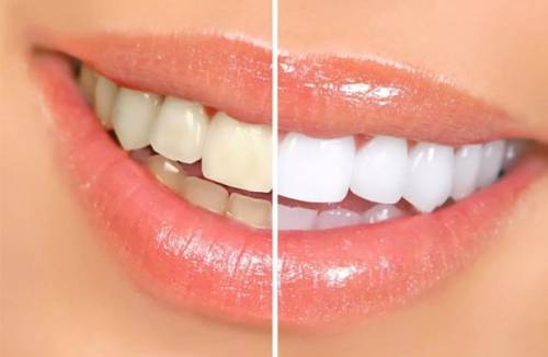 8 способов отбелить зубы в домашних условиях