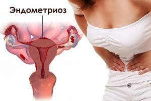 5 мифов об эндометриозе