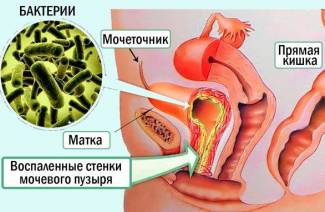Как лечить инфекцию мочевого пузыря домашними средствами