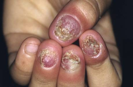 Чем лечить грибок ногтей на руках
