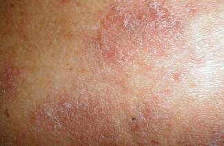 Аутоиммунные заболевания кожи