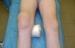 Изображение - Диагноз артроз коленного сустава 2 степени deformiruyucshij-osteoartroz-kolennogo-sustava_w110_h70