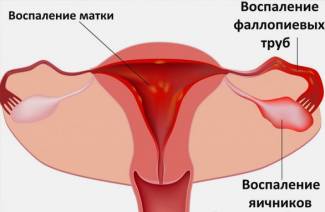 Симптомы аднексита