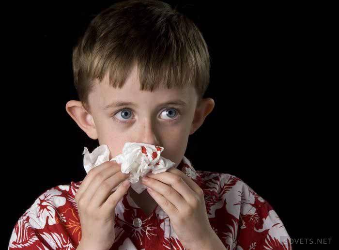 Как правильно остановить кровь из носа у маленьких детей?