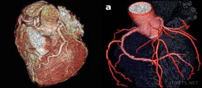 Спиральная компьютерная томография сердца