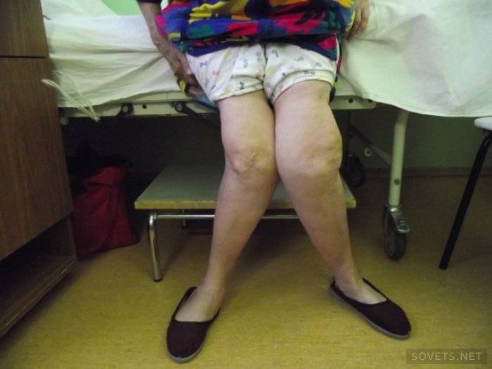 Лечение артроза коленного сустава народными средствами