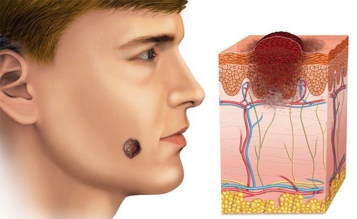 Базалиома кожи лица лечение