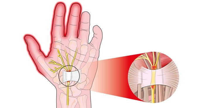 Немеет левая рука (парестезия) - причины онемения, лечение