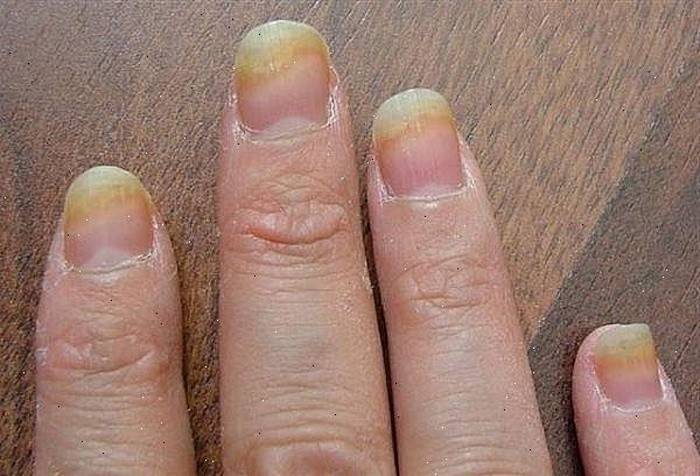 Грибковые заболевания кожи волос и ногтей 13