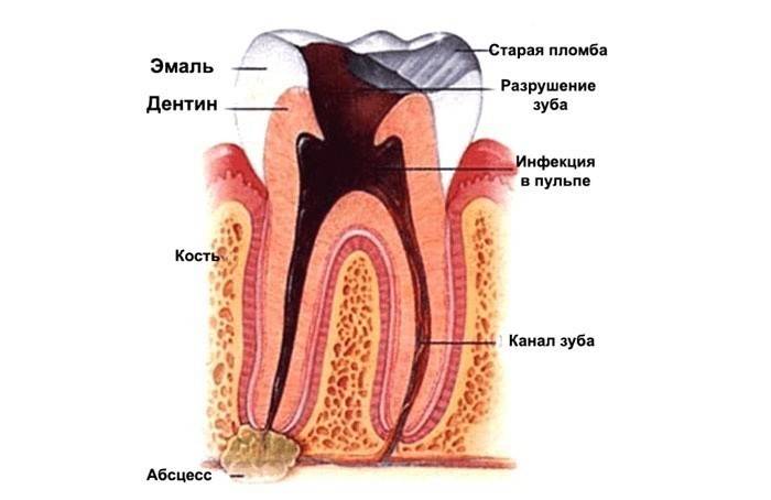 Причина боли в запломбированном зубе