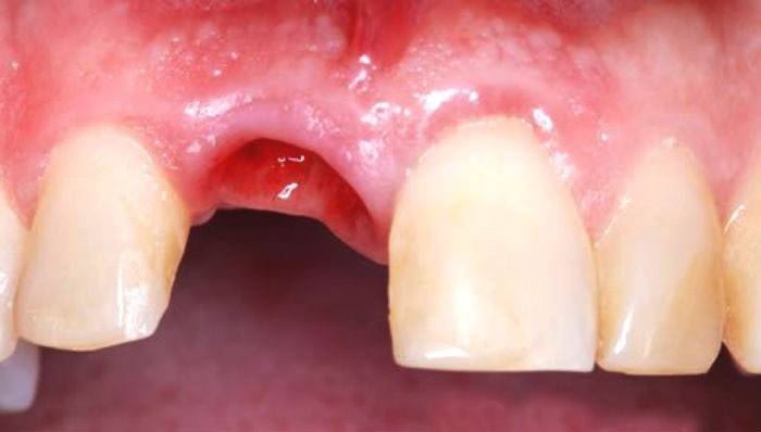 Боль после удаление зуба