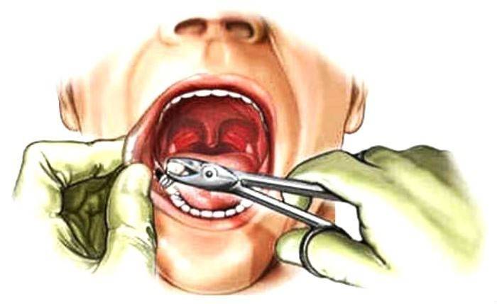 Удаление зуба