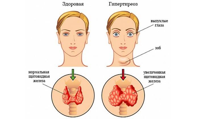 Сравнение здоровой щитовидной железы и гипертиреоза