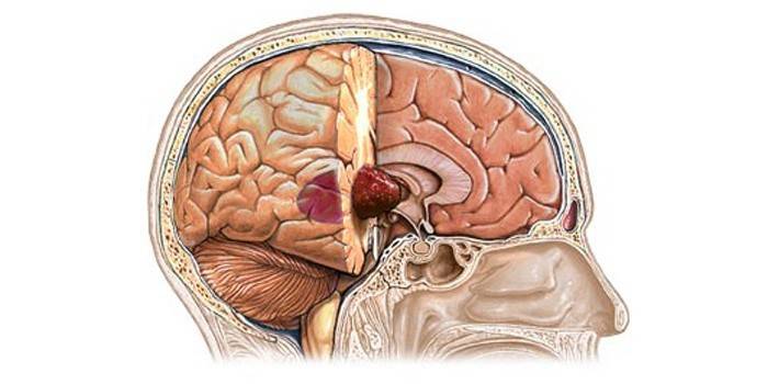 Опухоль в головном мозге человека