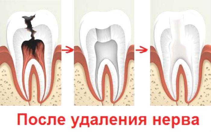 Зуб после удаления нерва