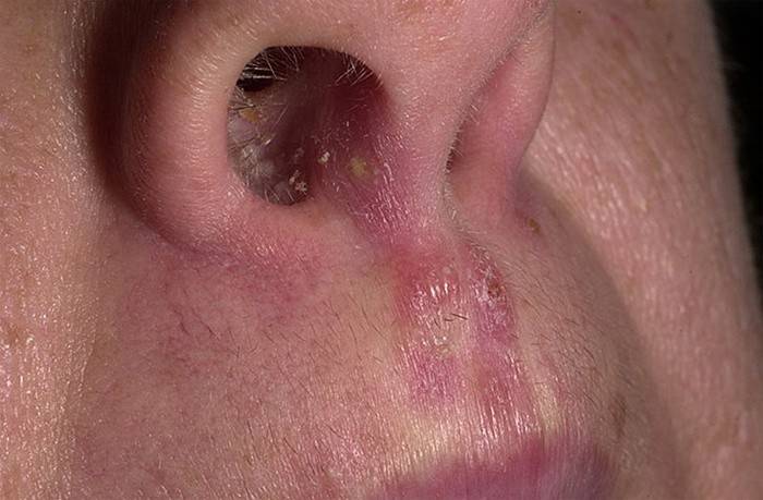 Симптом грибка в носу