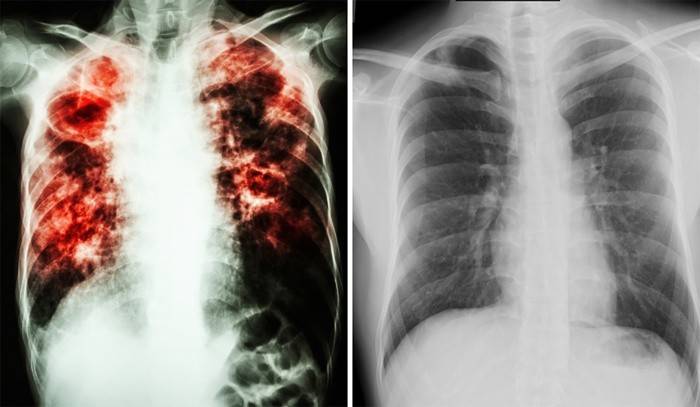 Признак туберкулеза