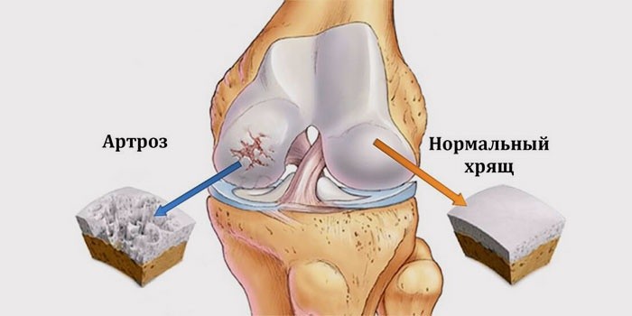 Изображение - Боли около коленного сустава 1099686-3gonartroz-artroz-kolennogo-sustava