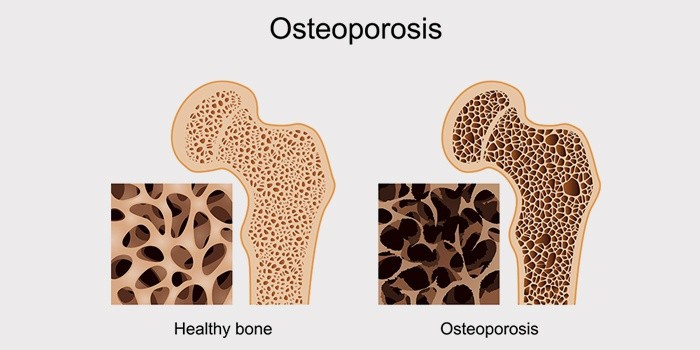 Что такое остеопороз костей