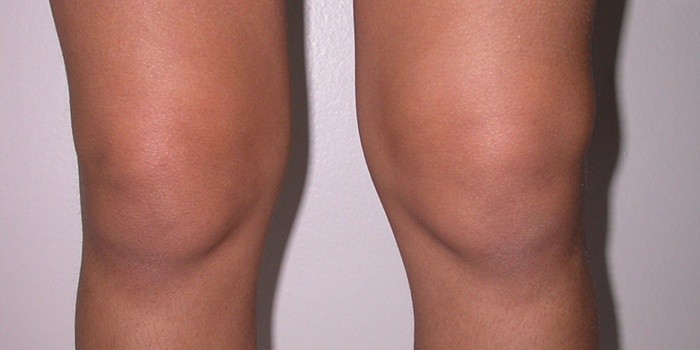 Бурсит коленного сустава симптомы