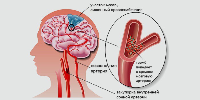 Как вылечить ишемию головного мозга