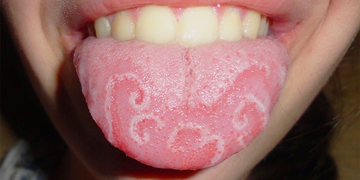 Опасно ли воспаление языка глоссит