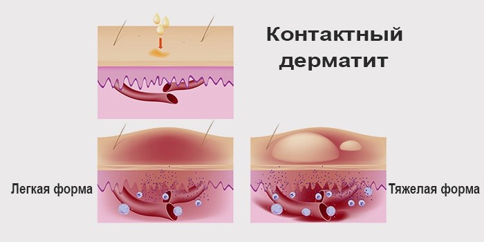 Аллергический контактный дерматит лечение