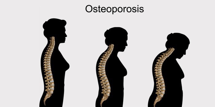 Что такое остеопороз костей