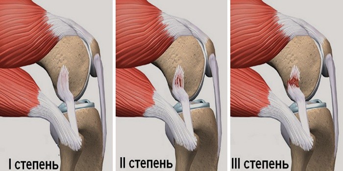 Признаки повреждения мениска коленного сустава