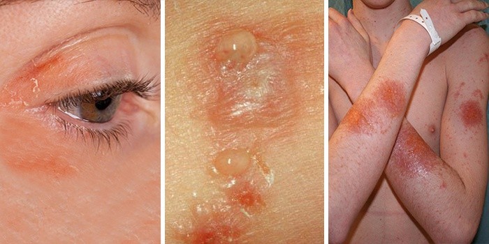 Аллергический контактный дерматит лечение