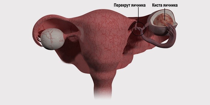 Киста с перекрутом и секс, фильмы про