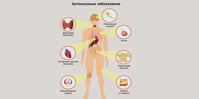 Аутоиммунные заболевания суставов лечение народными средствами рентген сустава бутово