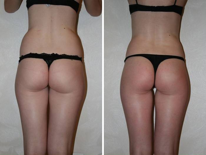 Фото до и после процедур лимфодренажного массажа