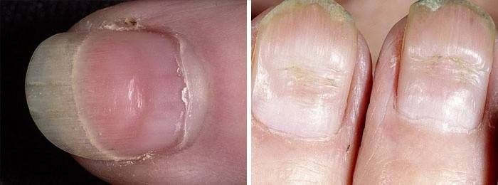 Внешние характеристики дистрофии ногтя – борозды Бо
