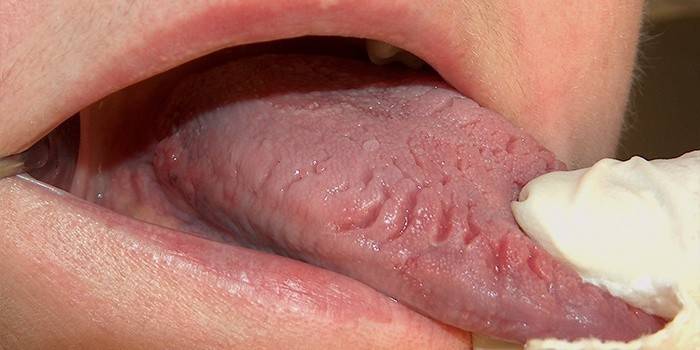 Симптомы глоссита на языке у человека