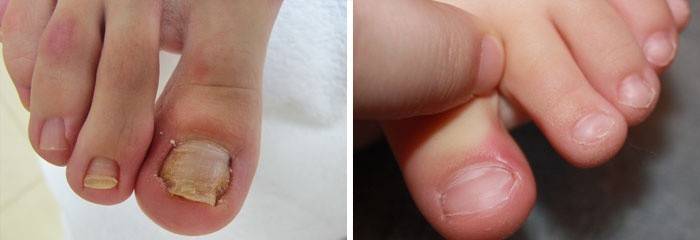 Причины воспаления вокруг ногтя на ноге