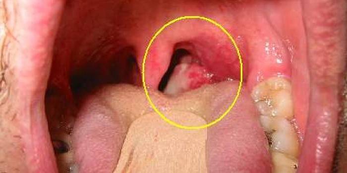 Симптомы рака горла в начальной стадии