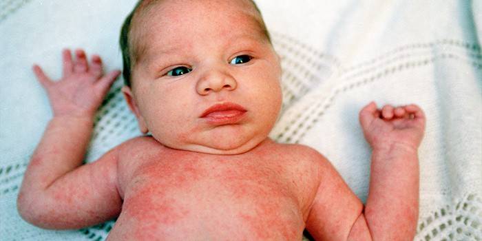 Сыпь при аллергии у ребенка