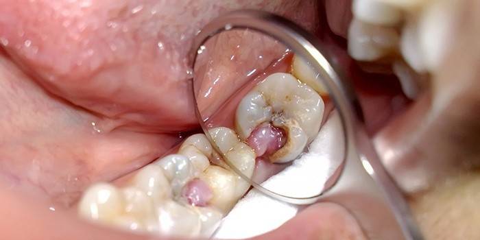 Пульпит, при котором необходимо удаление зубного нерва