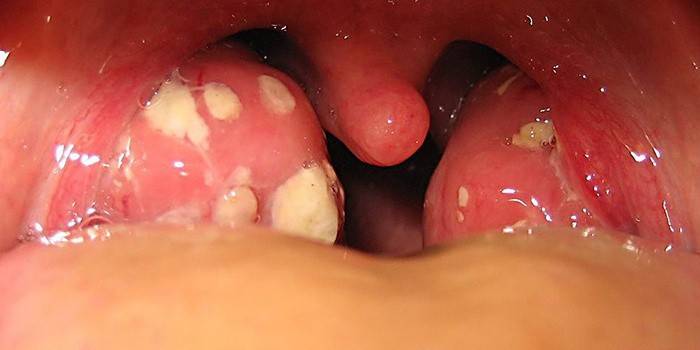 Воспаленные миндалины в горле