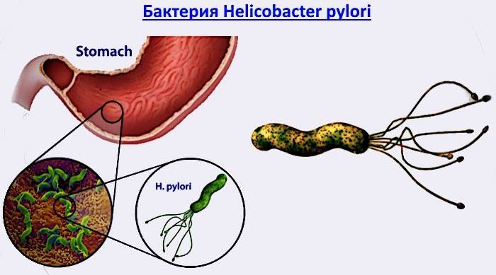 Бактерия Helicobacter pylori провоцирующая болезнь желудка
