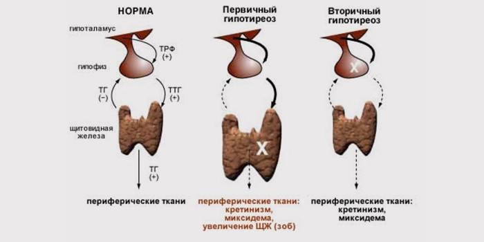 Стадии гипотиреоза щитовидной железы